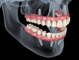 eating after dental implants