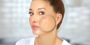 best prescription acne cations for