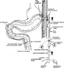 Jejunostomy Tube Your Guide To A Healthier Life