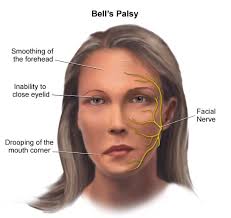Life With Bell's Palsy