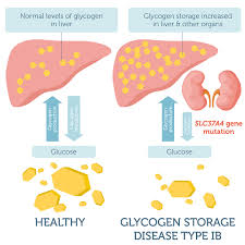 glycogen storage disease type ib dna