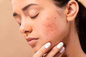 how long does acne laser treatment take