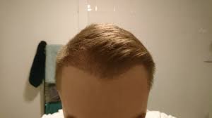 At seven months this is what it's supposed to look like with relatively fine hair, and i would guess it'll be 30 or 40 or 50 percent better at a year and a month. Fue Post Op Pictures 4 Months Hair Transplant Story