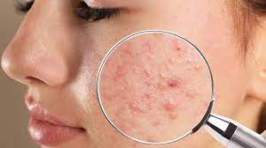 acne scars and dark spots what are