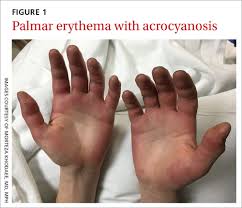 Inaugural manifestation of hiv infection eur j dermatol. Acute Bilateral Hand Edema And Vesiculation Mdedge Family Medicine