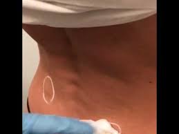 lower back dimples injections in nyc