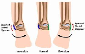types of ankle sprains symptoms and