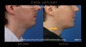 Male Mentoplasty Surgery In New York | Jaw & Chin Enhancement TreatmentMale  Plastic Surgery