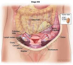 This is mainly due to accumulation of fluid (called. Ovarian Cancer Medlineplus Genetics