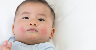 baby rash under chin drool rash heat