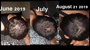 The old skin is shed. 9 Months On Finasteride Only And Shedding The Whole Time Iron Supplements Slowed Down The Shed The Point Is Shedding Doesn T Mean Hairloss Tressless