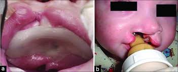 infants born with cleft lip and palate