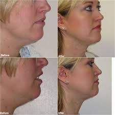 We did not find results for: Vaser Chin And Neck Liposuction Jag Chana