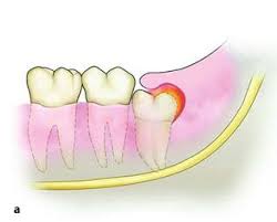 what is a soft tissue impacted tooth
