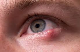 how to treat an eye stye