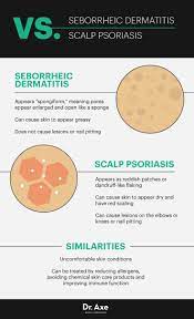 causes and risk factors of seborrheic dermais