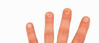 signs and ses of nail fungus progression