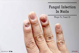 fungal infection in nails ways to
