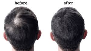 microneedling for hair loss in men