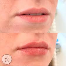 lipfiller 0 5ml before after