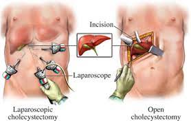 laparoscopic gallbladder surgery
