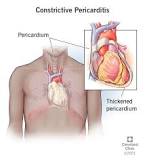 Image result for icd 10 code for chronic pericarditis