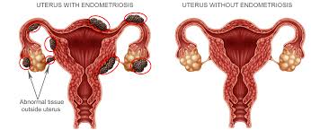 Endometriosis is a condition where tissue similar to the lining of the womb starts to grow in other places, such as the ovaries and fallopian tubes. You Vs Endometriosis Endometriosis Treatment Nyc