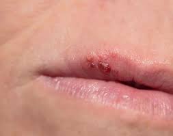cold sore healthily