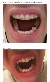 Middleberg to make an appointment to have your wire slid. Are Braces Worth It Quora