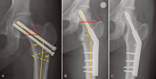 fem neck fractures treatment of