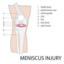 surviving a meniscus injury bowen