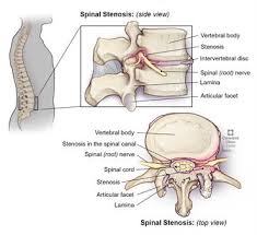 These muscles provide posture and stability to the body by holding the vertebral column erect and adjusting the position of the body to maintain. Spinal Stenosis What Is It Symptoms Causes Treatment Surgery