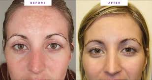 makeup after microdermabrasion your