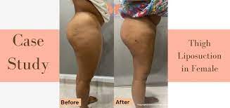 case study thigh liposuction in