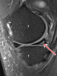 Resultado de imagen de tear meniscus mri