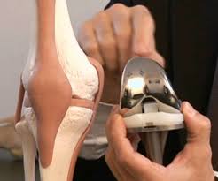 knee prosthesis total knee replacement