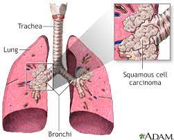 lung cancer small cell information