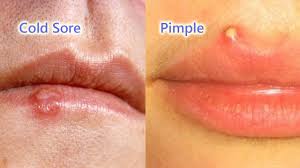 a pimple or a cold sore