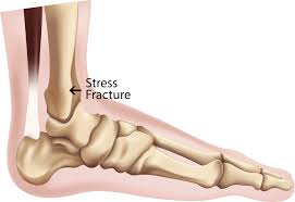 symptoms of a stress fracture in the