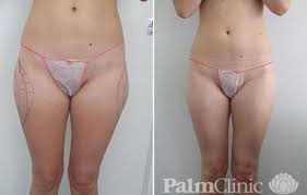 thighs liposuction before and after