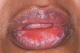 chronic edema of the lips a rare but