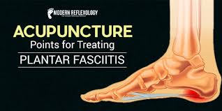 4 Effective Acupuncture Points For Treating Plantar Fasciitis