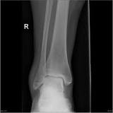 Image result for icd 10 code for avulsion fracture of distal fibula