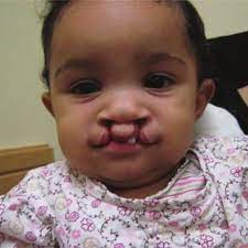 bilateral cleft lip with cleft