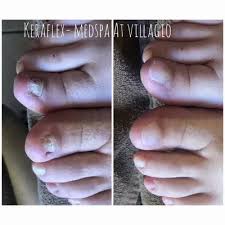 toenail fungus treatment medspa at