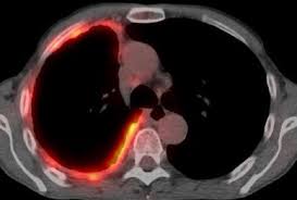 There is no effortlessly recognized single demonstration or event quickly obvious because openness to asbestos might have happened 20, 30, or 40 years before analysis, making it hard to follow. Current Therapies For Malignant Pleural Mesothelioma Environmental Health And Preventive Medicine Full Text