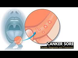 what is canker sores causes signs and