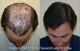 This should help us figure out what's real or fake about his physical changes. Celebrity Hair Transplant Clinic For Men And Women In Minnesota Cass Leader