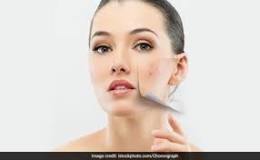 does-putting-vaseline-on-pimples-help