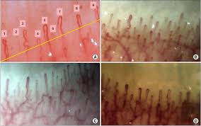 nailfold capillaroscopic finding